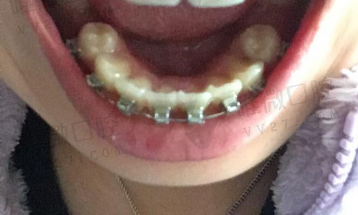 假牙和临时牙有什么区别,临时牙看起来假吗(图1)